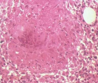 Figure 37-5, Bone marrow granuloma.