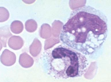 Figure 37-6, Peripheral blood in Clostridium perfringens septicemia demonstrating microspherocytes, neutrophils with toxic granulation, vacuolization, and Döhle bodies and erythrophagocytosis.