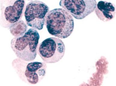 Figure 37-8, Intramonocytic morula in human monocytic ehrlichiosis.