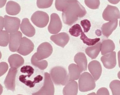 Figure 37-9, Morula-infected neutrophil in human granulocytic anaplasmosis.