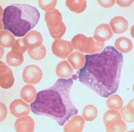 Figure 37-10, Atypical lymphocytes (Downey cells) in infectious mononucleosis.