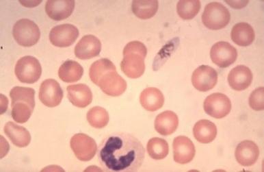 Figure 38-4, A Plasmodium falciparum malarial gametocyte in the blood.