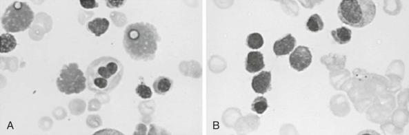 Figure 38-7, Bone marrow from a person with Plasmodium falciparum malaria. A , Multinucleate red blood cell precursors. B , Intercytoplasmic bridging (Leishman stain, magnification ×500).