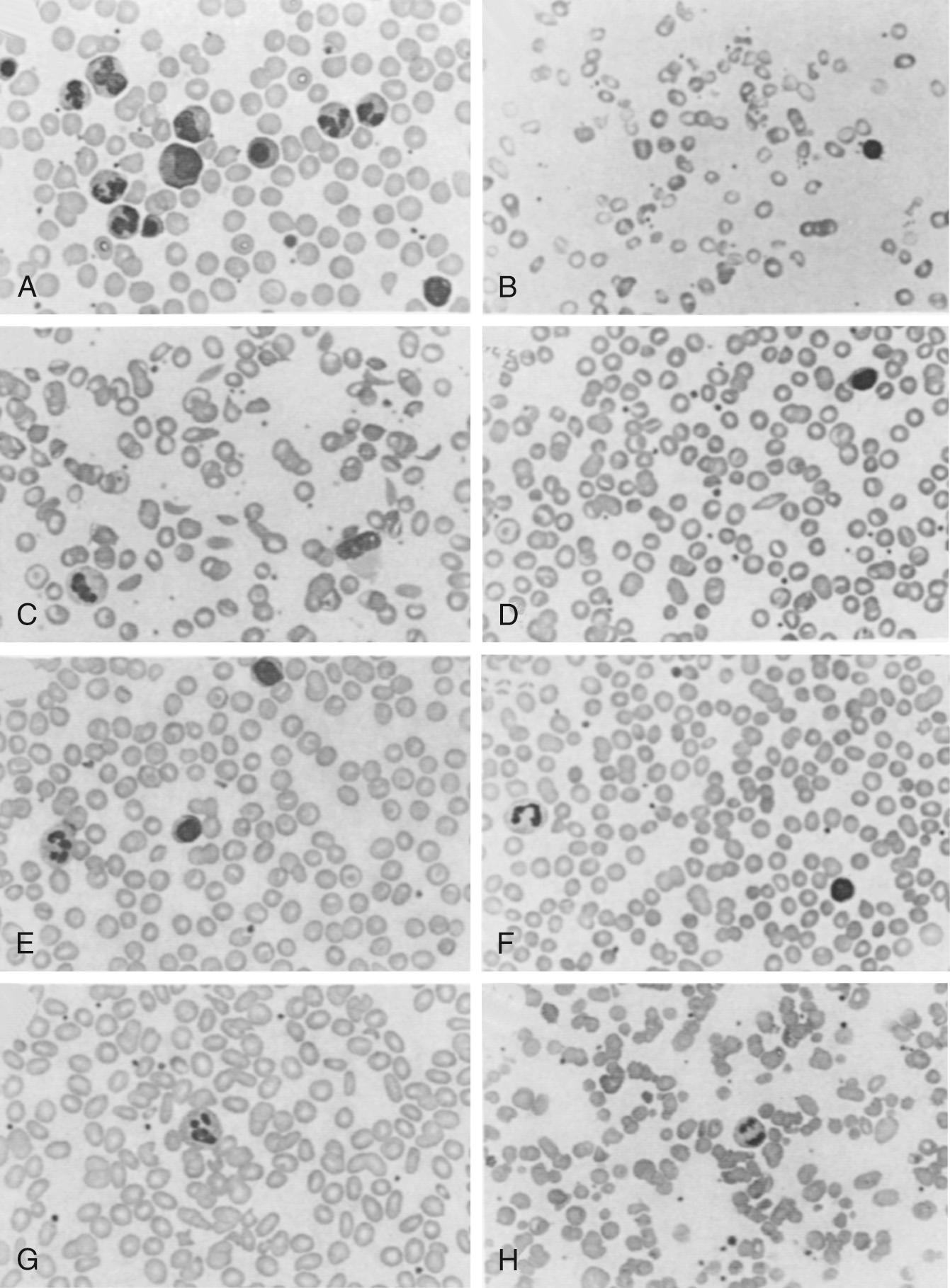 Fig. 79.7, Peripheral blood smears. A, Premature newborn of 26 weeks’ gestation. B, Iron deficiency. C, Hemoglobin SS. D, Hemoglobin SC. E, Hemoglobin CC. F, Hereditary spherocytosis. G, Hereditary elliptocytosis. H, Hereditary pyropoikilocytosis.