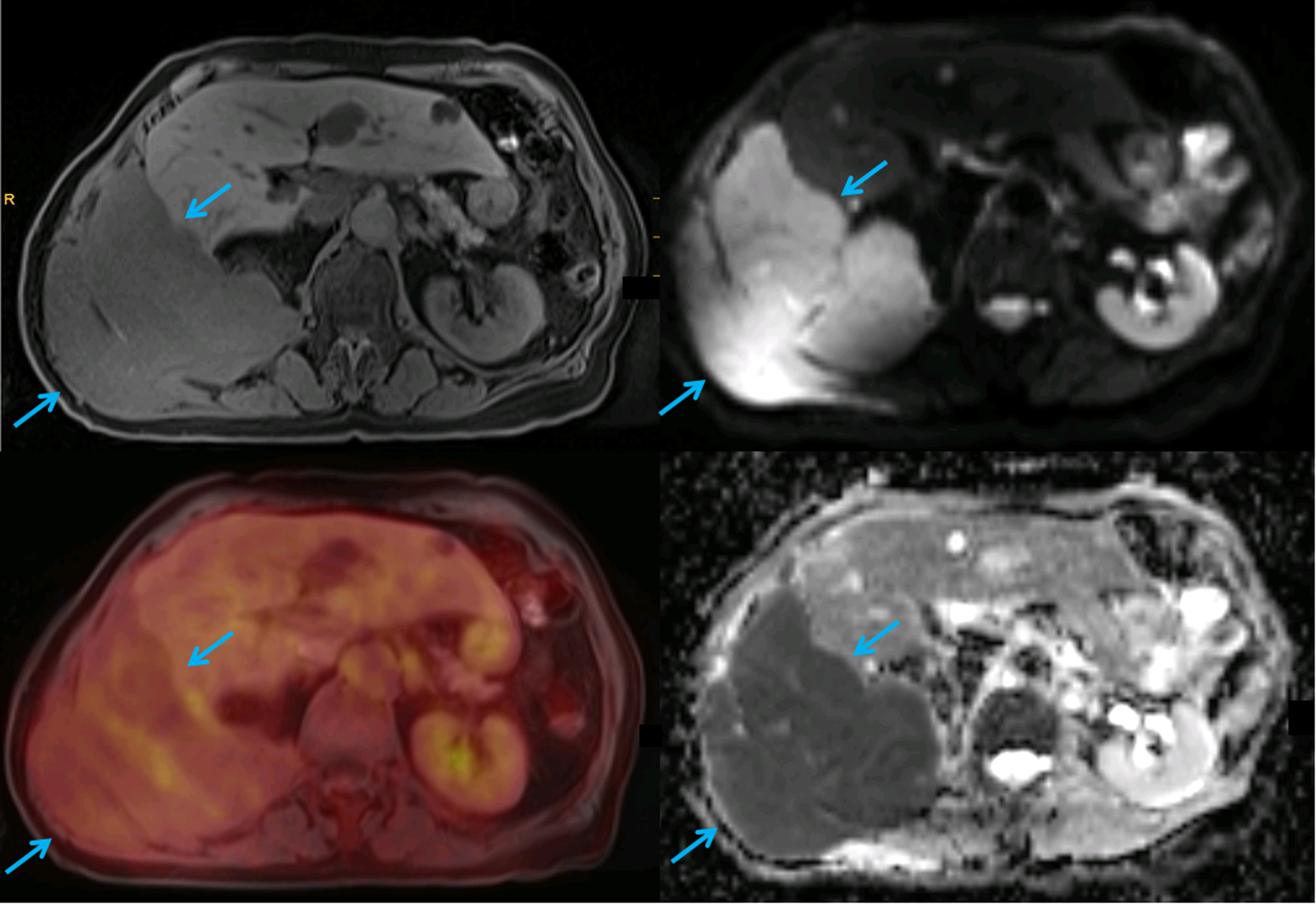 Figure 9.1, A 65-year-old patient with macroglobulinemia Waldenström. A large soft-tissue mass infiltrating through the right posterior abdominal wall (blue arrows) is well visible on the T1-weighted fat-saturated MR image (top left) and shows high signal on DWI (top right) and low signal on the ADC map (bottom right), consistent with diffusion restriction and high cell density. However, due to the slow growth, the lesion shows low FDG uptake on the fused color-coded PET/MRI image (bottom left), similar to physiological liver uptake.