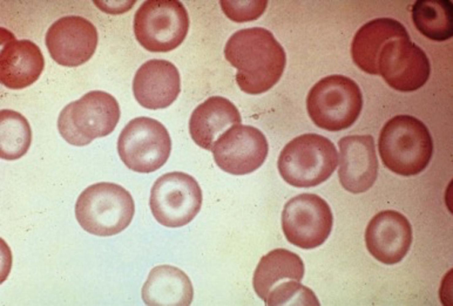 Fig. 9.2, Target cells in obstructive liver disease. In contrast to the target cells in hypochromic-microcytic anemias, the target cells in liver disease are normal in size and well hemoglobinized.