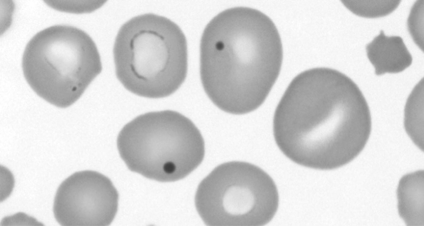 Fig. 9.3, Red blood cells with Howell-Jolly bodies in a patient with hyposplenism. The cytoplasmic inclusions are nuclear remnants.