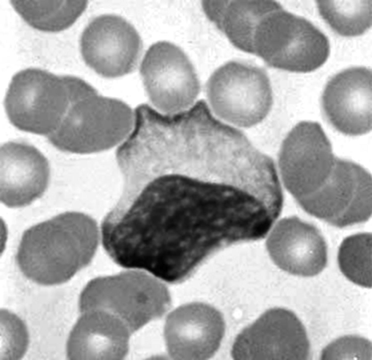 Fig. 9.4, Atypical lymphocyte. Note the deformation of the lymphocyte by the adjacent red cells.