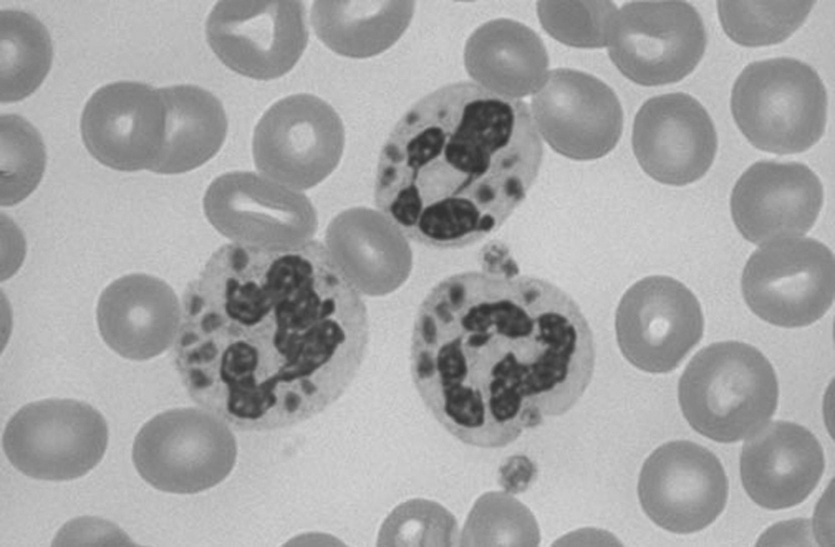 Fig. 9.5, Chédiak-Higashi syndrome, microscopic peripheral blood smear demonstrating giant lysomal granules in the white blood cells.