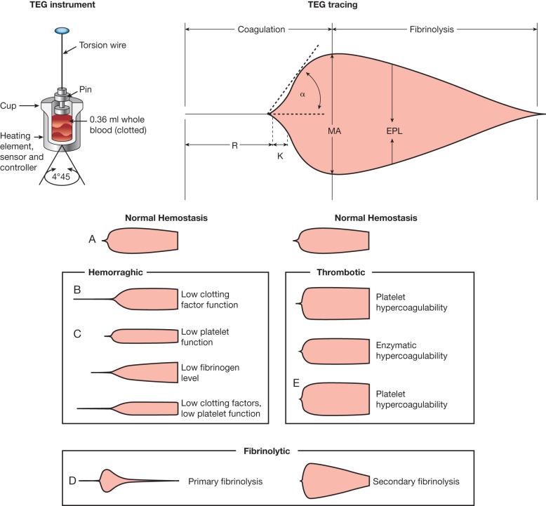 Fig. 22.1, Panel 1 depicts the thromboelastography (TEG) device, in which a cuvette of whole sample blood is incubated with a pin and torsion wire rotates within the sample. The tracing depicted in Panel 2 reflects the force required to spin the pin over time as the fibrin strands form a clot which resists pin movement. R (reaction time) in minutes reflects the latency time to initial fibrin formation. Elevations are typically treated with frozen fresh plasma (FFP) or reversal of anticoagulants, which delay initiation of clot formation. K (kinetics) is the time taken to achieve a clot strength of 20 mm. α is the angle between R and K and measures the speed of fibrin build up and cross-linking, which reflects the availability of fibrinogen; defects are typically treated with cryoprecipitate. TMA (time to maximum amplitude) is another measure of speed to fibrin build up. MA (maximum amplitude) represents the ultimate strength of the fibrin clot and overall stability and is a measure of platelet action and stabilization of the clot. Deficits in MA are typically treated with platelets or ddAVP to augment platelet aggregation. FPL, A30, or LY30 reflects the amplitude of the clot strength at 30 minutes as a measurement of fibrinolysis. Fibrinolytic patterns are treated with TXA typically. (A) Normal TEG tracing. (B) Low clotting factor availability causing a decreased α-angle. (C) various pathological hemorrhagic TEG tracings. (D) Fibrinolytic TEG tracings. (E) Various thrombotic TEG tracings.