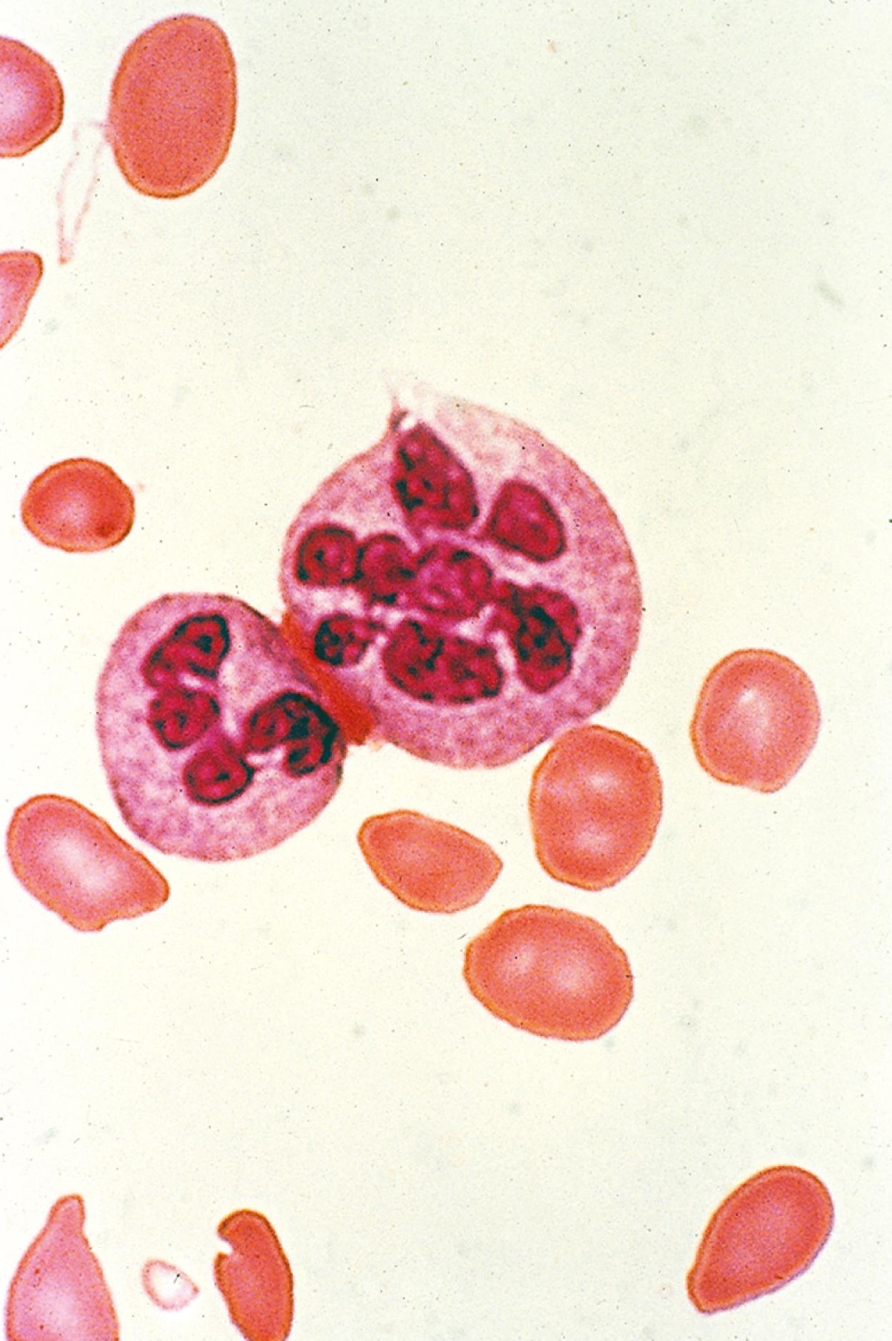 Fig. 12.11, This peripheral blood smear demonstrates the presence of a hypersegmented polymorphonuclear leukocyte in a patient with phenytoin-induced folate deficiency.