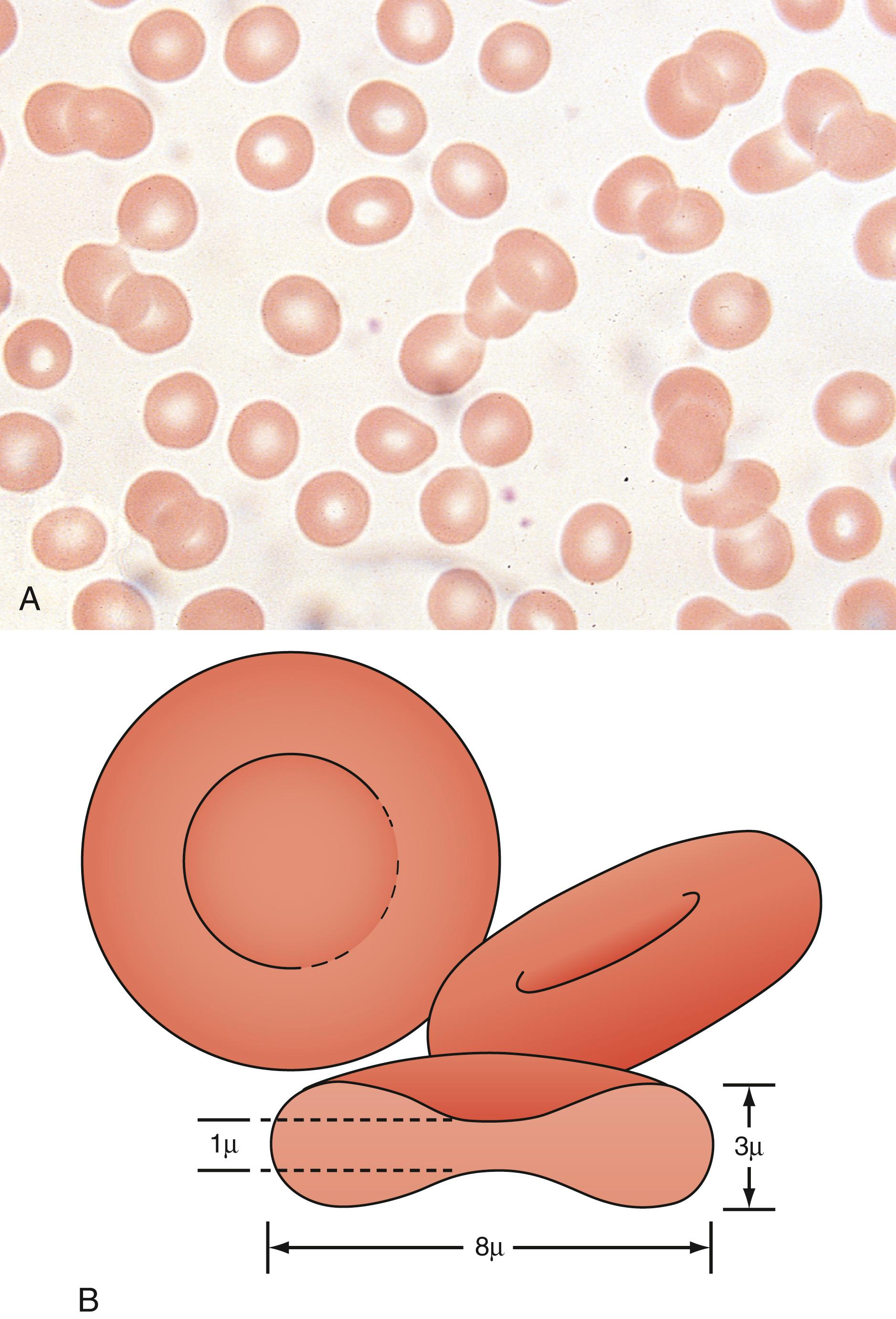 Fig. 12.2, Peripheral blood smear. The appearance of a normal peripheral blood smear when viewed under high power (×400). (A) Biconcave structure of the red blood cell (RBC). (B) Schematic drawing of an RBC in two views, demonstrating the features of the normal biconcave disk.