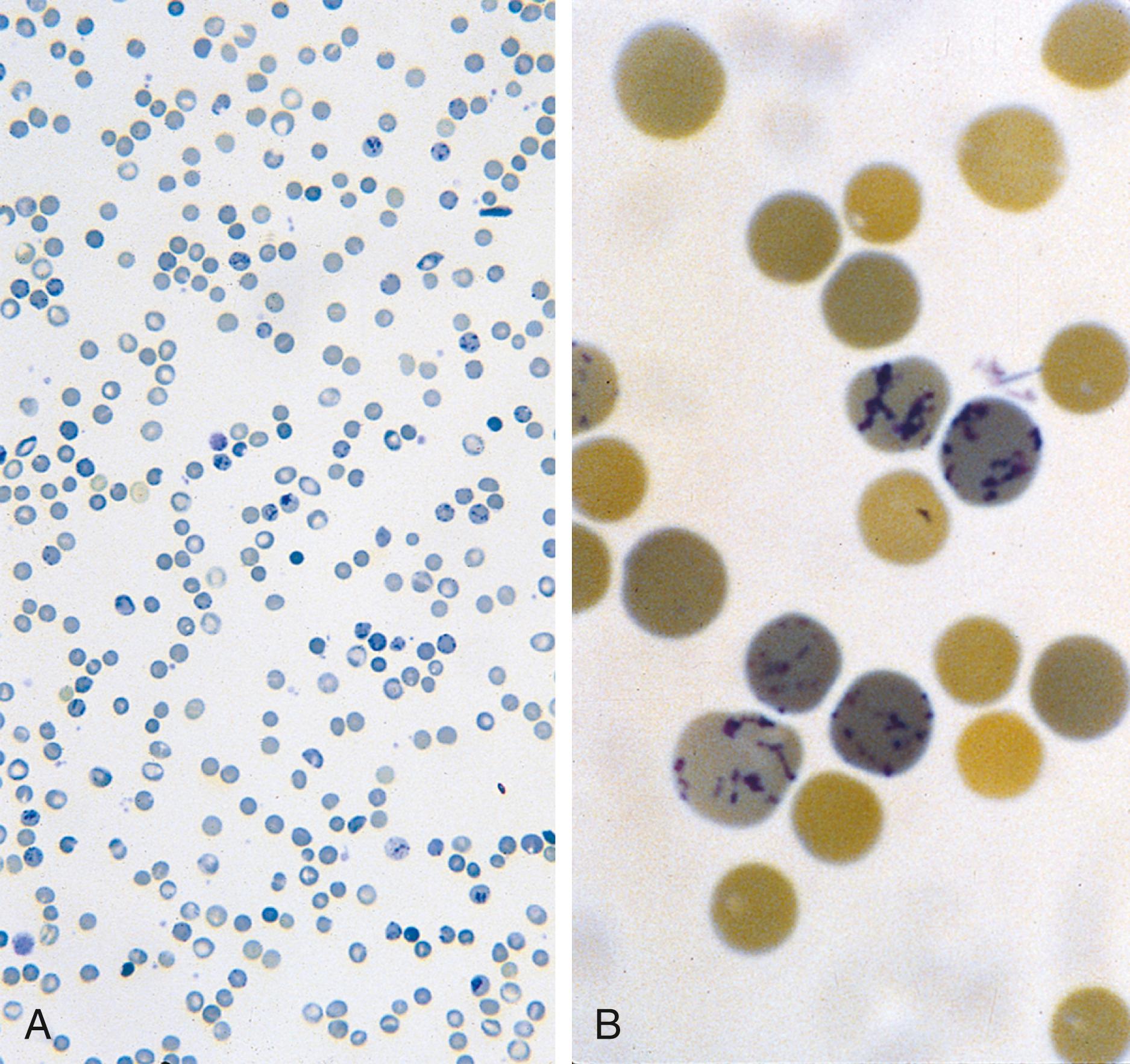 Fig. 12.3, The reticulocyte. (A) A reticulin-stained peripheral blood smear in a patient with a high (18%) reticulocyte count. The darkly stained cells are reticulocytes seen in the peripheral blood of a patient with hemolytic anemia. (B) High magnification of reticulocytes.