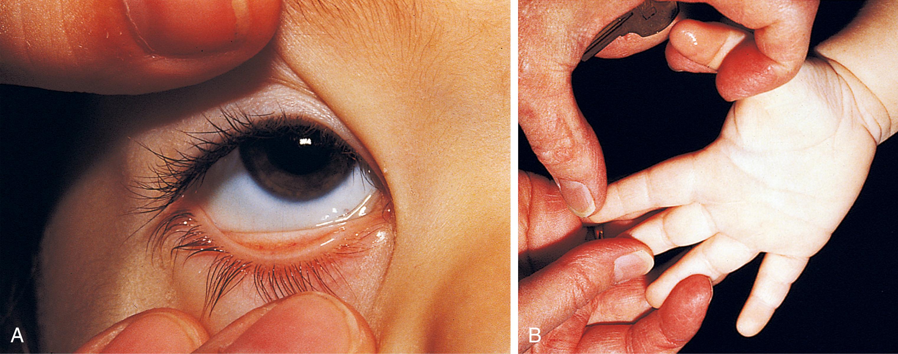 Fig. 12.4, Severe anemia. (A) Pale conjunctiva may be seen in the patient with severe anemia. (B) Pale palmar creases are also visible in cases of severe anemia. The child in this photograph has a hemoglobin level of 4 g/dL.