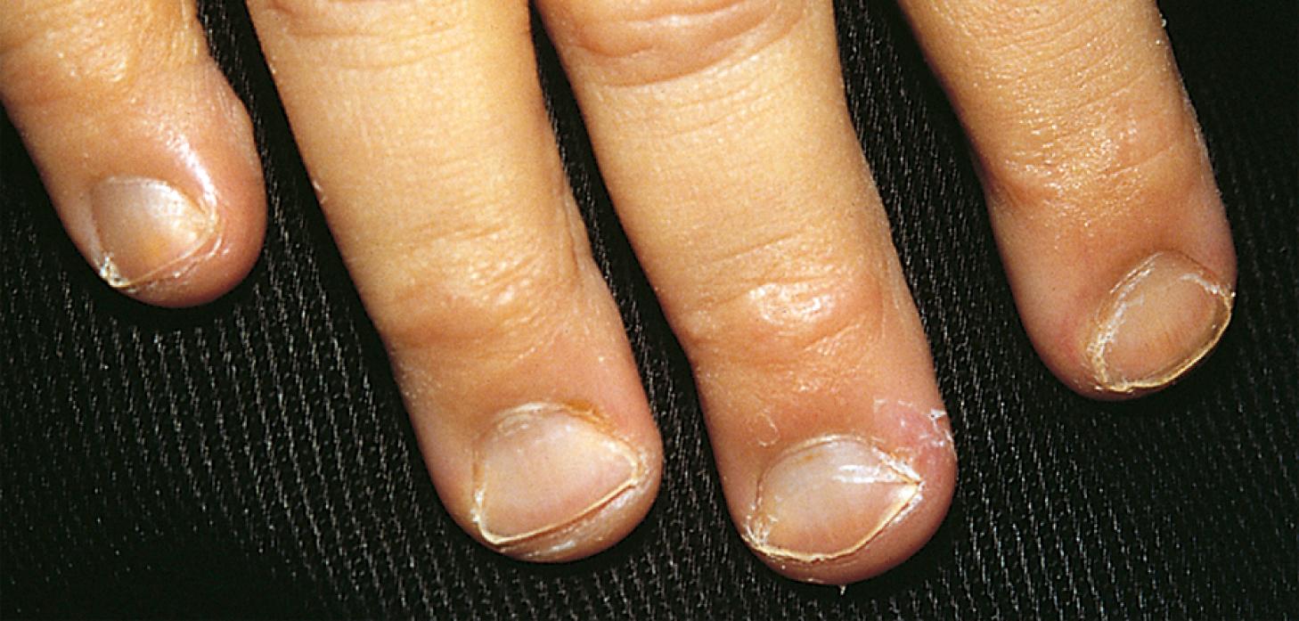 Fig. 12.5, Spooning of the fingernails occurs in children with severe iron deficiency anemia.