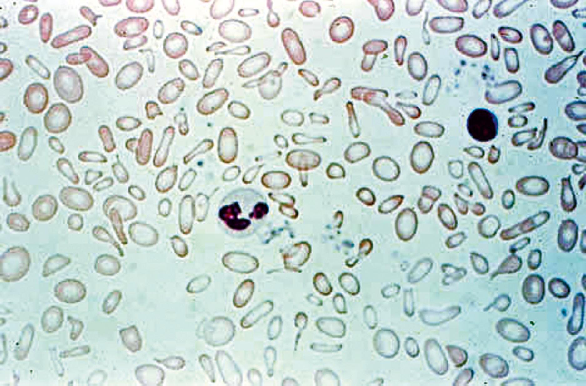 Fig. 12.6, Iron deficiency results in a hypochromic, microcytic anemia. This 16-month-old patient had a history of excessive milk intake. Note the marked central pallor of the red blood cells (RBCs) with their small rim of hemoglobin, as well as their small size in comparison with that of the adjacent lymphocyte nucleus. Frequent “cigar cells” can be seen in addition to the hypochromic microcytic RBCs.