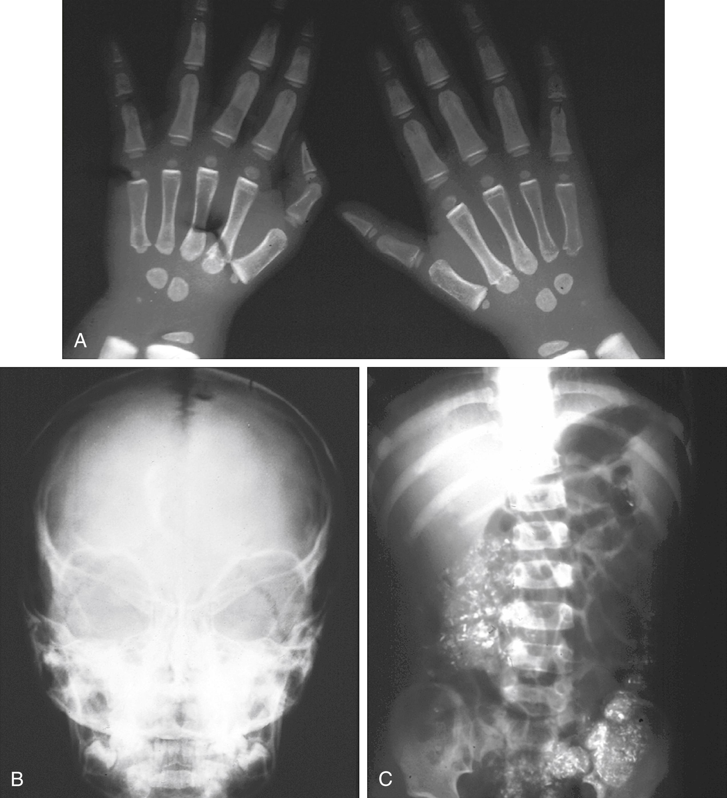 Fig. 12.7, X-ray findings in lead intoxication. (A) This hand radiograph of a child with lead intoxication reveals marked linear increases in the density of the metaphyses. These should not be confused with the growth arrest lines that may be seen after a variety of illnesses. (B) A skull film is shown of a patient with lead intoxication and encephalopathy. Note the split of sutures indicative of increased intracranial pressure. (C) An abdominal radiograph performed on a child with a history of pica and lead intoxication reveals radiodense, lead-containing paint chips scattered throughout the colon.
