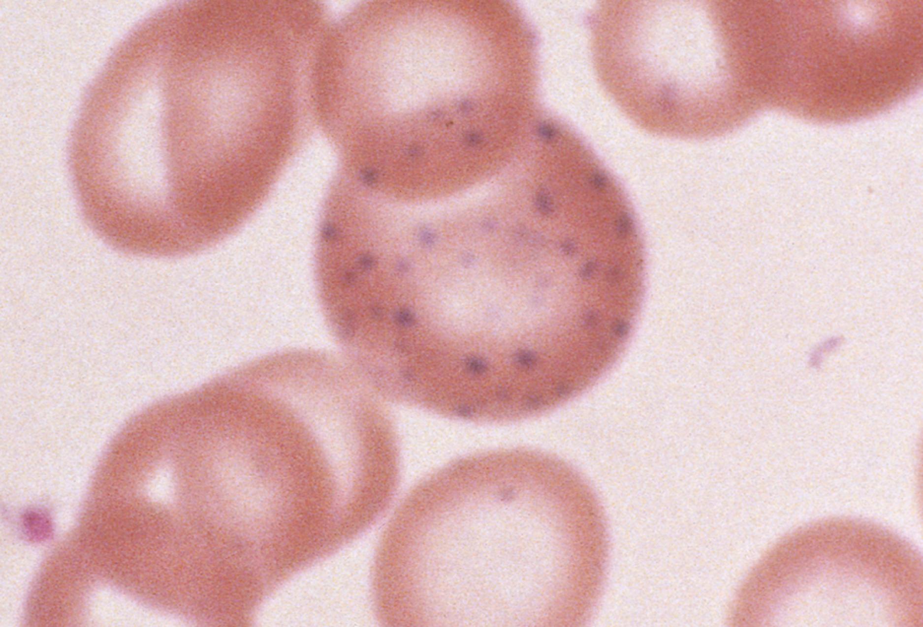 Fig. 12.8, Prominent basophilic stippling is often seen in thalassemia and treated iron deficiency, but classically is thought of in cases of severe lead intoxication. However, this finding is not specific for any diagnosis.