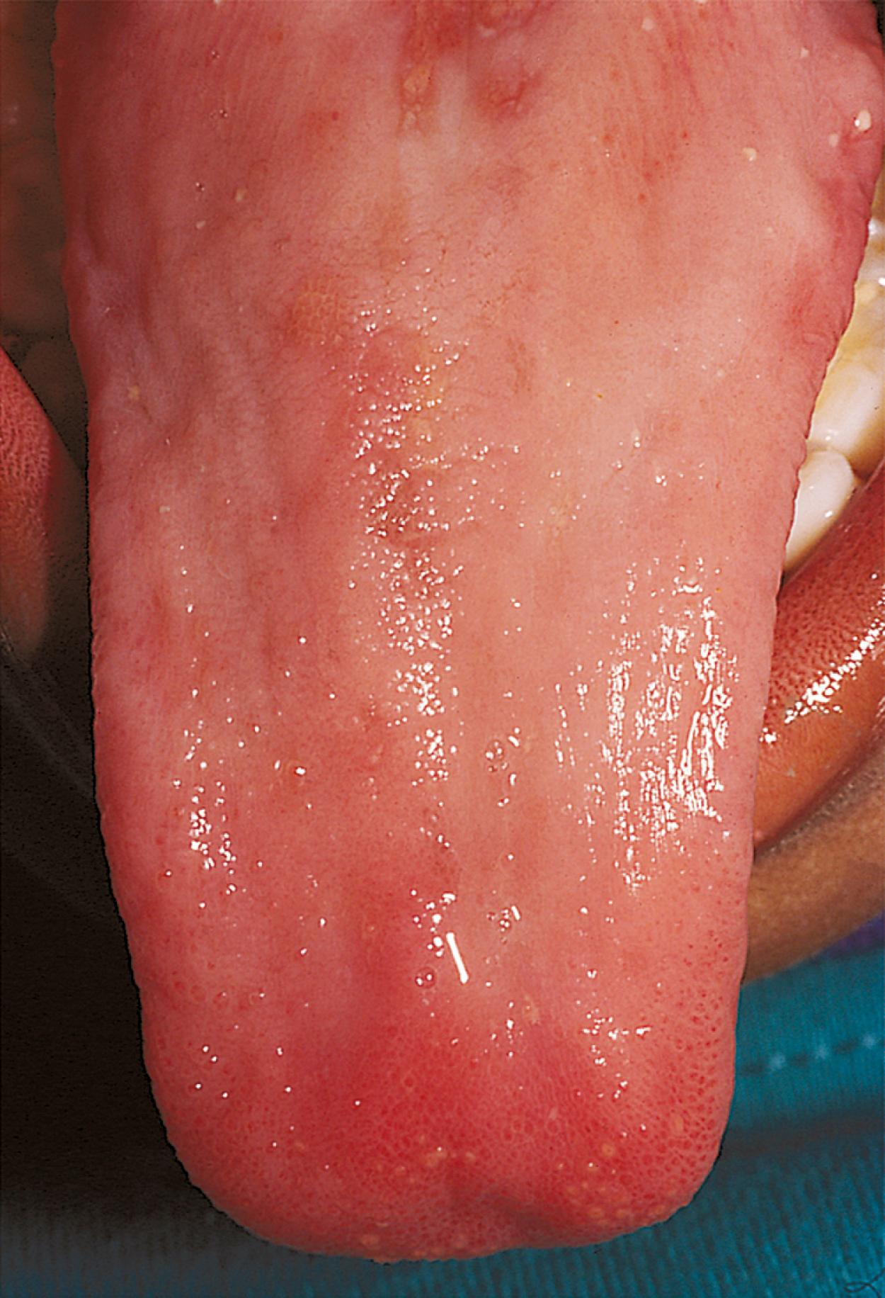 Fig. 12.9, A smooth, beefy red tongue may be observed in the physical examination of a patient with vitamin B 12 deficiency. This patient depended on total parenteral nutrition for several years without vitamin B 12 supplementation.