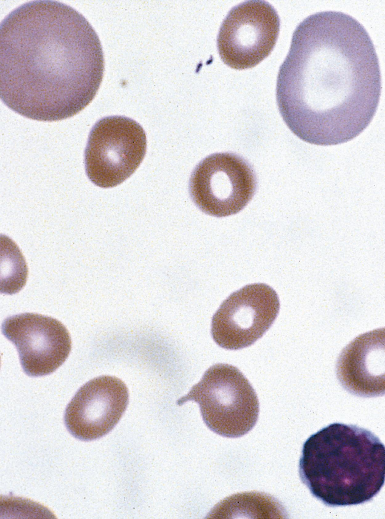 Fig. 12.10, Megaloblastic anemia. This peripheral blood smear demonstrates an enlarged red blood cell (RBC; macrocyte) at the upper left of the photograph. The RBC is much larger than the normal small lymphocytes in the same field in this patient with megaloblastic anemia.