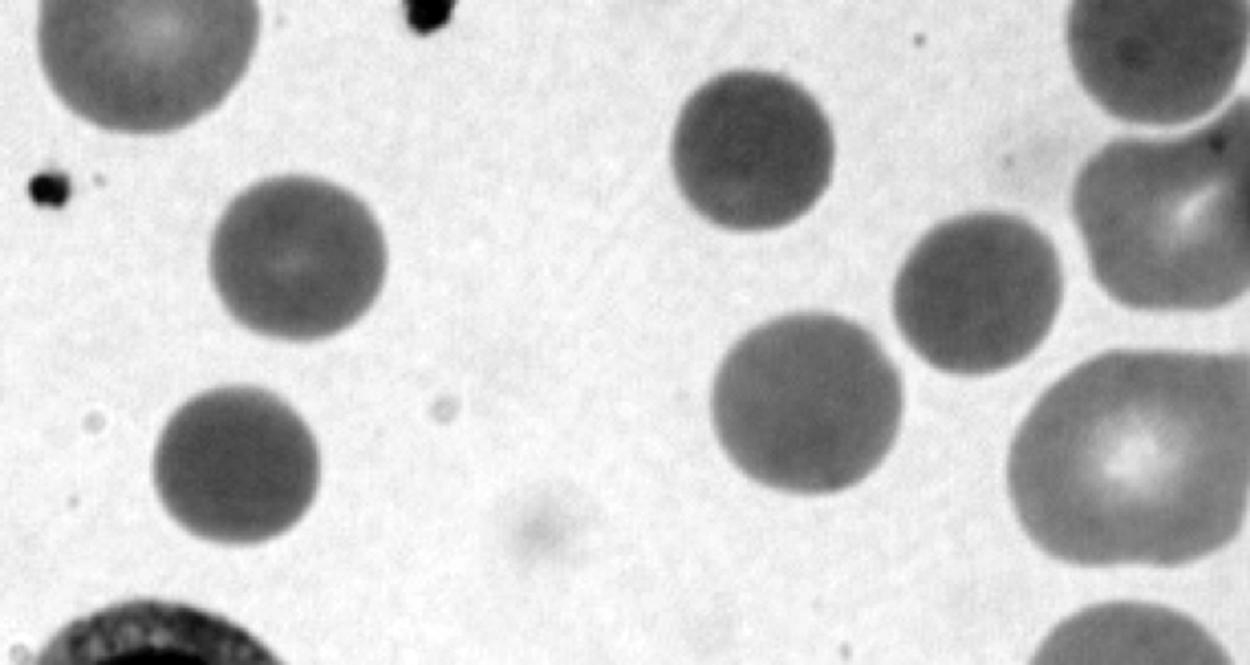 Figure 12-6, Photomicrograph of a Wright-stained blood film of a newborn infant with autosomal dominant hereditary spherocytosis. Note that many erythrocytes lack a zone of central pallor.