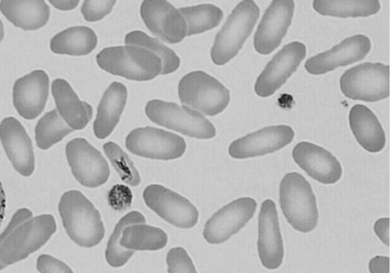 Figure 12-7, Photomicrograph of a Wright-stained blood film of a newborn infant with hereditary elliptocytosis. Note that most of the erythrocytes do have a zone of central pallor, but they vary in shape from round to oval to elliptical.