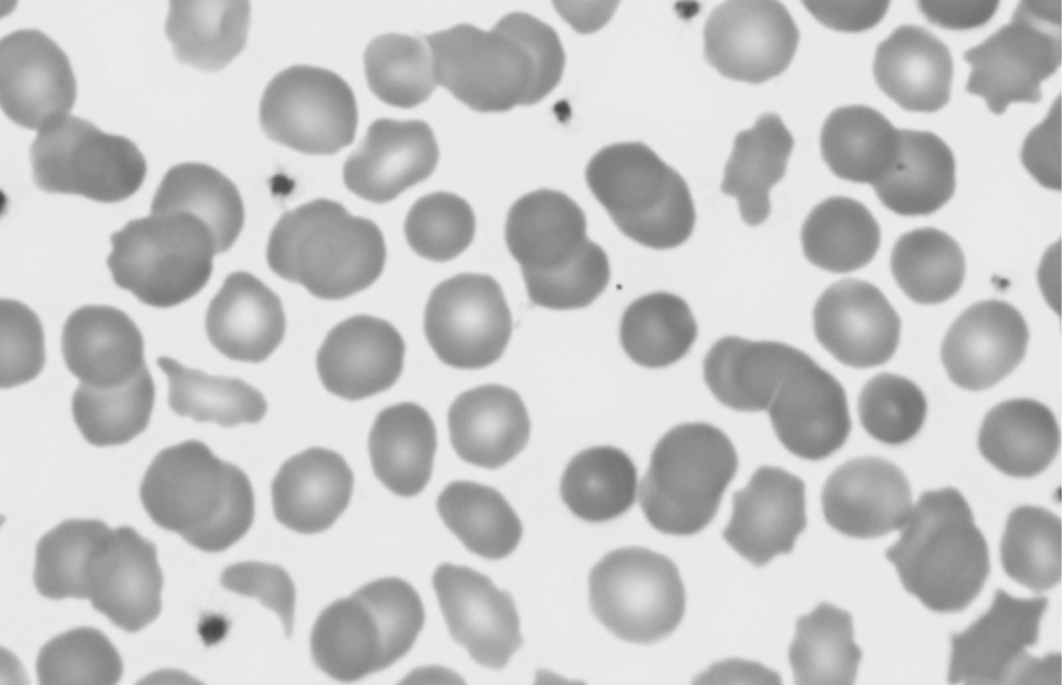 Figure 12-8, Photomicrograph of a Wright-stained blood film of a newborn infant with the diagnosis of pyropoikilocytosis. The mother had autosomal dominant hereditary elliptocytosis, and the father had a “silent” mutation in alpha-spectrin. Neither parent had problematic jaundice during the neonatal period or subsequently, but the baby required phototherapy for more than 1 week. Note that some of the erythrocytes appear normal, but many have abormal shapes, varying from spherocytes to schistocytes to acanthocytes. This high degree of poikilocytosis was termed pyropoikilocytosis because the cells resemble those after thermal burns (“pyro”).