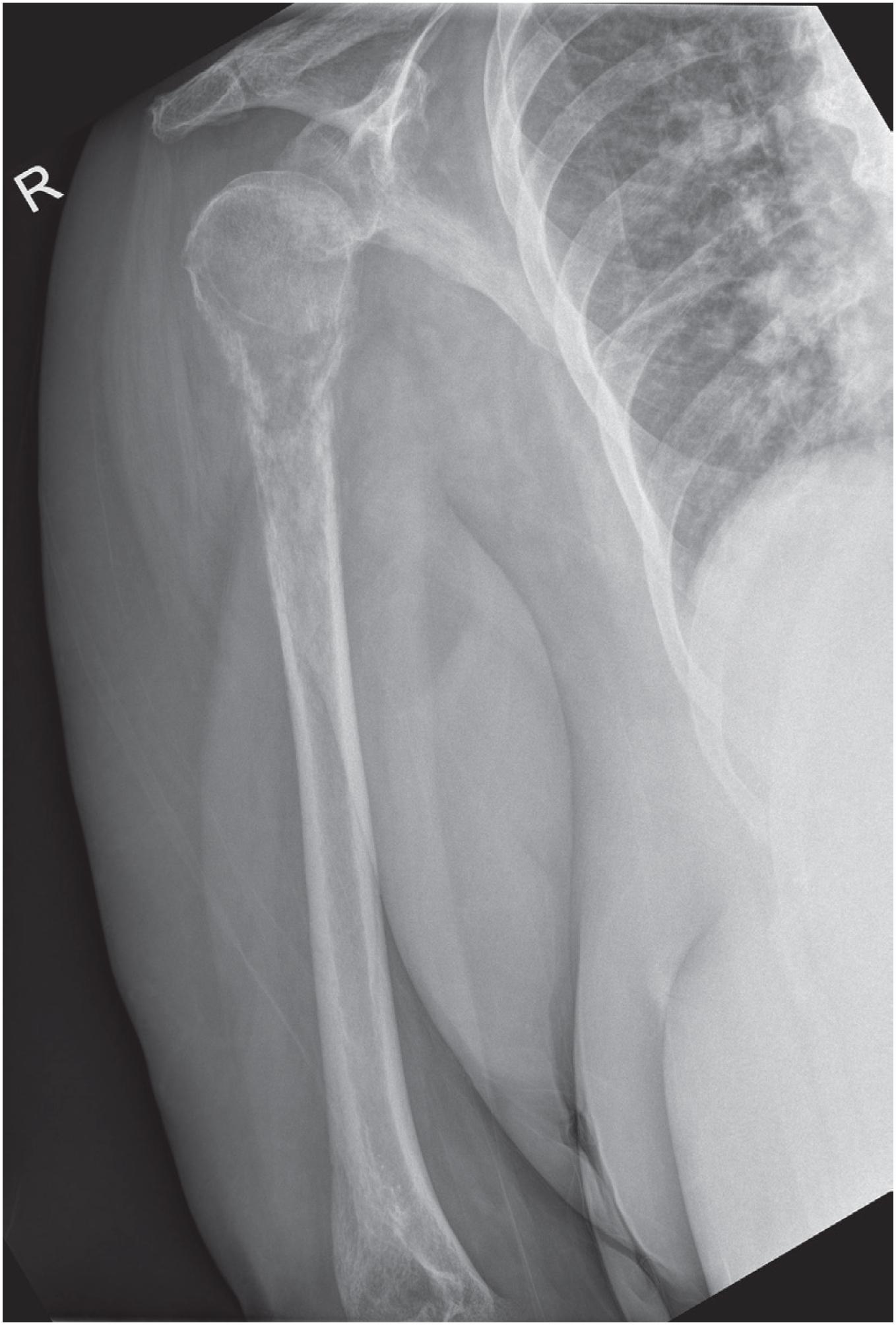 Fig. 19.1, Diffuse large B-cell lymphoma involving humerus, associated with fracture.