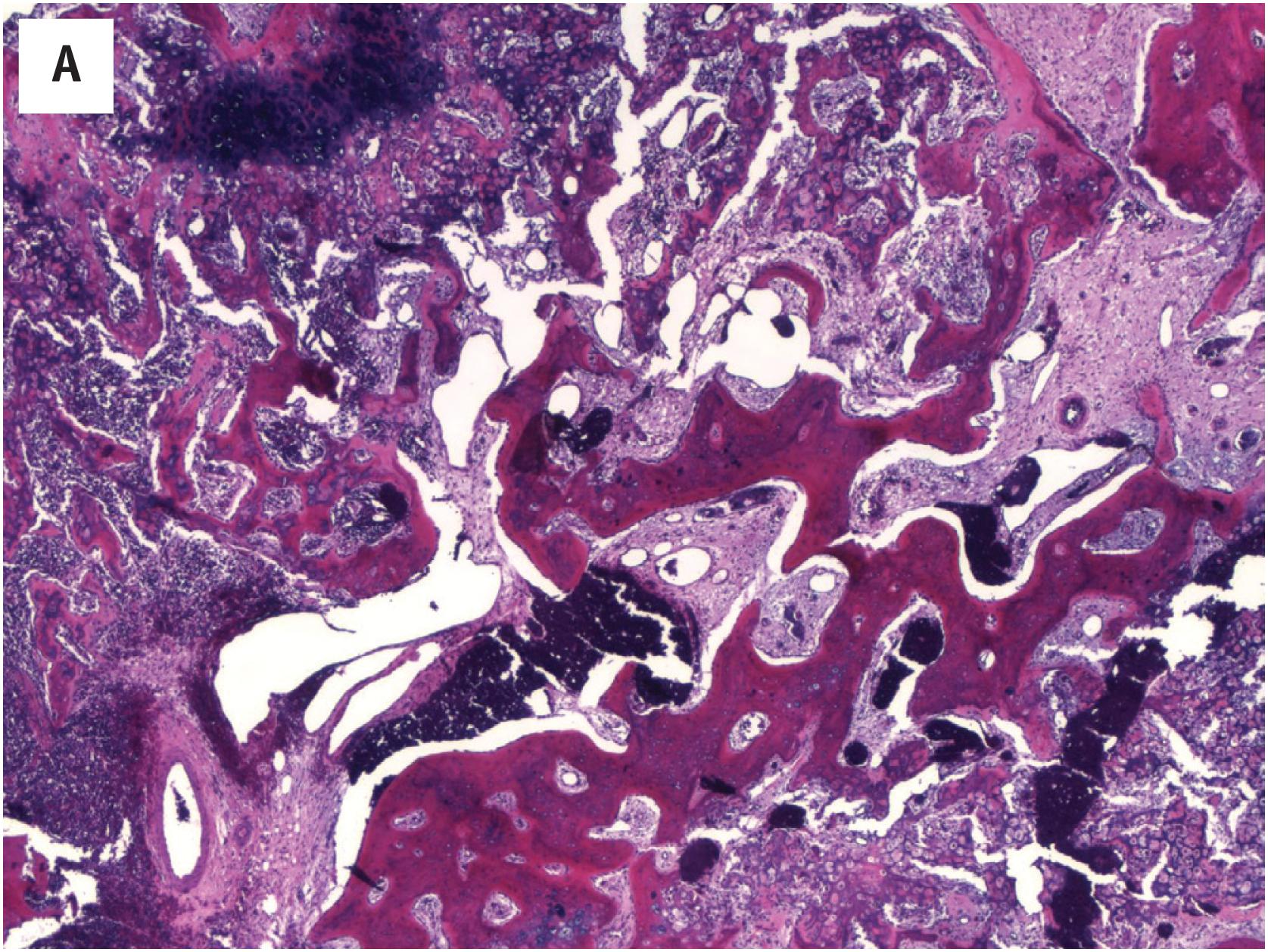 Fig. 19.2, Diffuse large B-cell lymphoma, associated with extensive fracture callus (A), infiltration of bony cortex (B), crush artifact (C), and extension into soft tissue (D). Neoplastic cells are large pleomorphic cells with vesicular to coarse chromatin and prominent nucleoli (E).