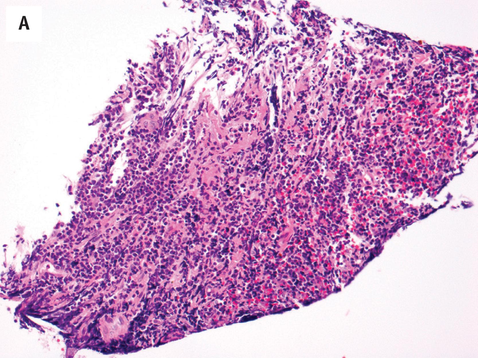 Fig. 19.3, B-lymphoblastic lymphoma involving sacrum. There is a dense infiltrate of closely packed cells replacing the normal tissue (A). High power reveals small to medium-sized atypical cells with fine chromatin and scant cytoplasm (B, H&E; C, Giemsa). Tumor cells are CD34+ (D) and TdT+ (E); D and E, immunoperoxidase stains on paraffin sections.