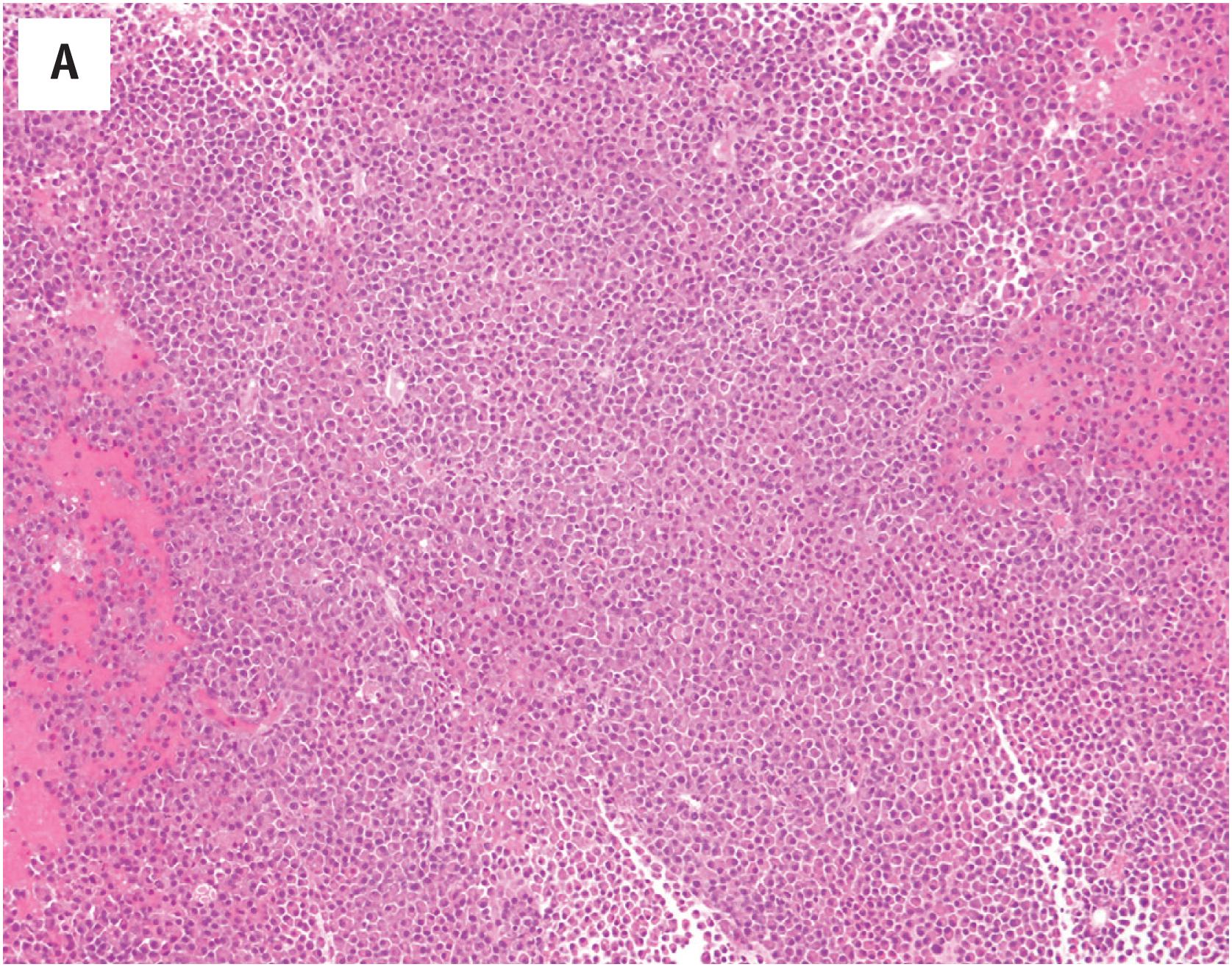 Fig. 19.5, Plasmacytoma involving the rib. A dense cellular infiltrate obliterates the normal tissue (A). Higher power reveals sheets of plasma cells (B); oil immersion reveals mature and many large atypical plasma cells, many with multiple small cytoplasmic inclusions of immunoglobulin (C). The plasma cells are CD138+ (D) and express monotypic kappa immunoglobulin light chain (E), while a stain for lambda is negative (D) (D–F, immunoperoxidase stains on paraffin sections).