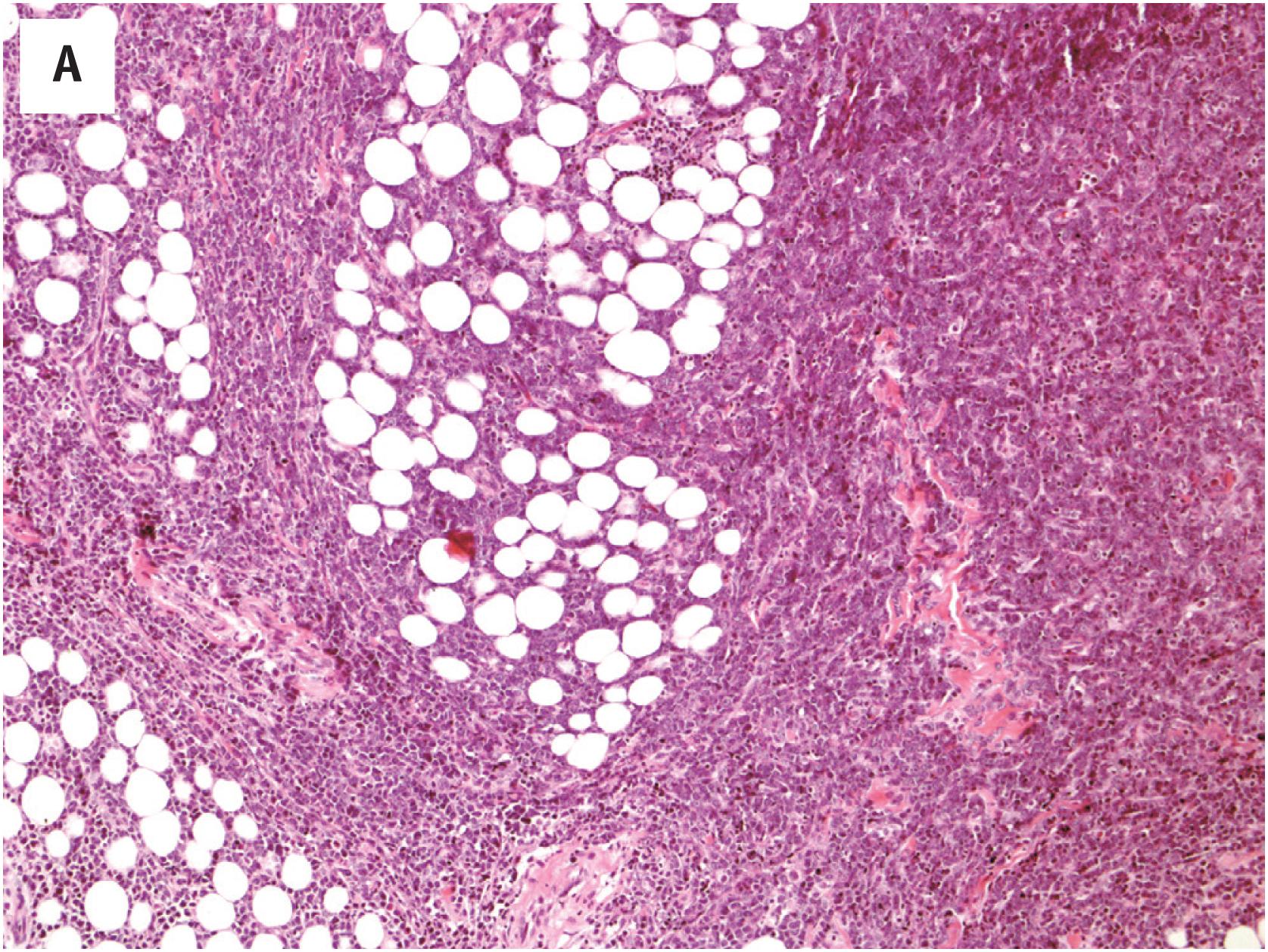 Fig. 19.6, Orbital myeloid sarcoma, bilateral, in a child. The lesions were associated with bilateral exophthalmos. Microscopic examination reveals a dense cellular infiltrate in soft tissue (A) with a linear pattern focally (B). Neoplastic cells have medium-sized to large oval nuclei, fine to vesicular chromatin and prominent nucleoli (C), with eosinophil precursors admixed in areas (D). Tumor cells express myeloperoxidase (E; immunoperoxidase technique on a paraffin section).