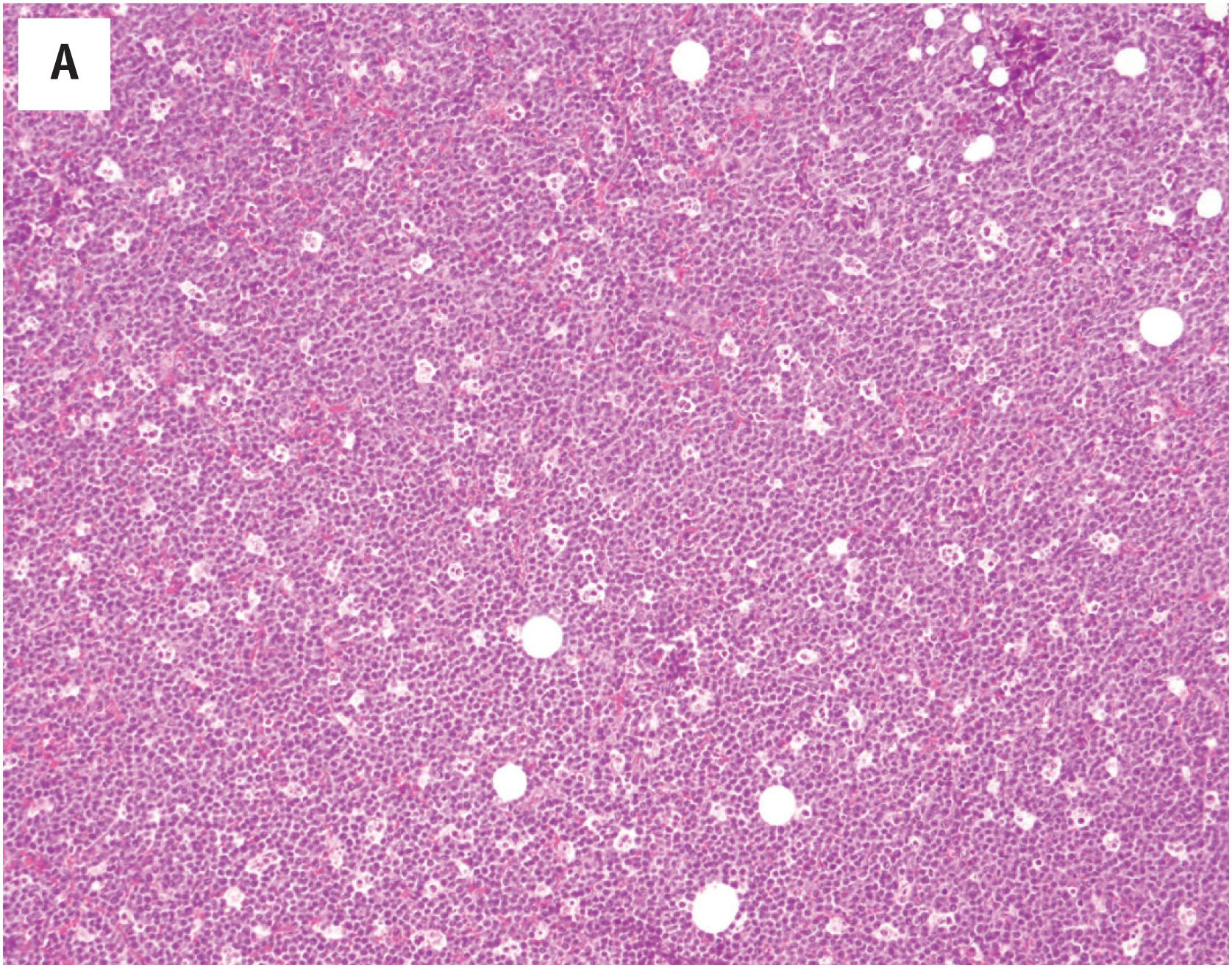 Fig. 19.7, Myeloid sarcoma with monoblastic immunophenotype (monocytic sarcoma), involving soft tissue. The patient had multiple osseous and soft tissue lesions, and developed a spontaneous fracture. Low power reveals a dense infiltrate with a prominent “starry sky” pattern (A). Neoplastic cells have oval, irregular, bean-shaped and bilobed nuclei, small to prominent nucleoli and a moderate amount of pink cytoplasm. Mitotic figures are readily identified (B). Tumor cells are CD43+ (C), CD4+ (D), CD56+ (E), lysozyme+ (F), CD68+ (G), CD34– (H). Tumor cells were also negative for myeloperoxidase (not depicted) (C–H, immunoperoxidase technique on paraffin sections).