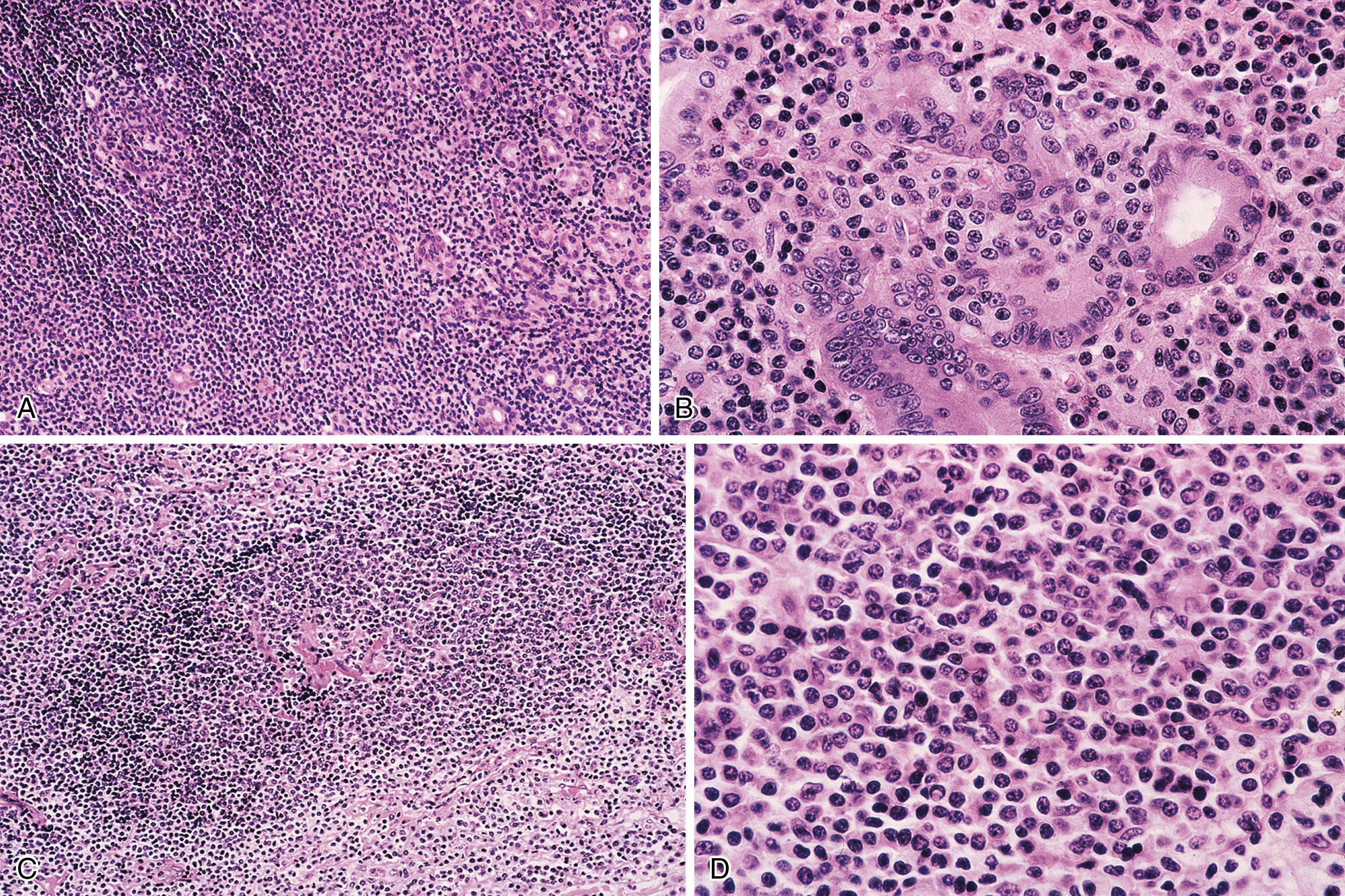 FIGURE 31.1, Gastric marginal-zone lymphoma.