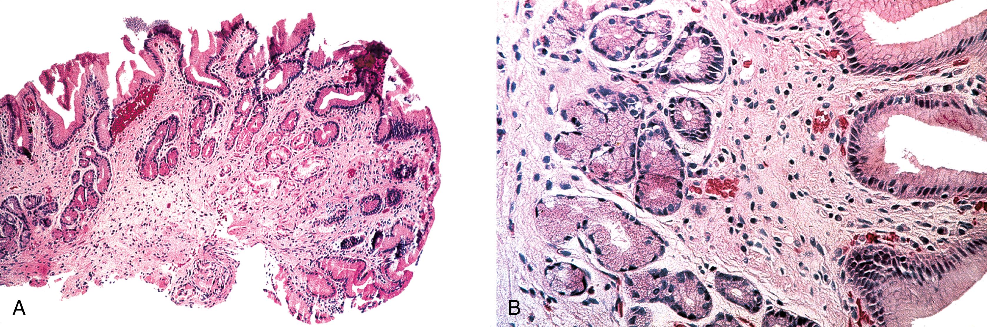 FIGURE 31.2, Gastric mucosa after regression of marginal-zone lymphoma.