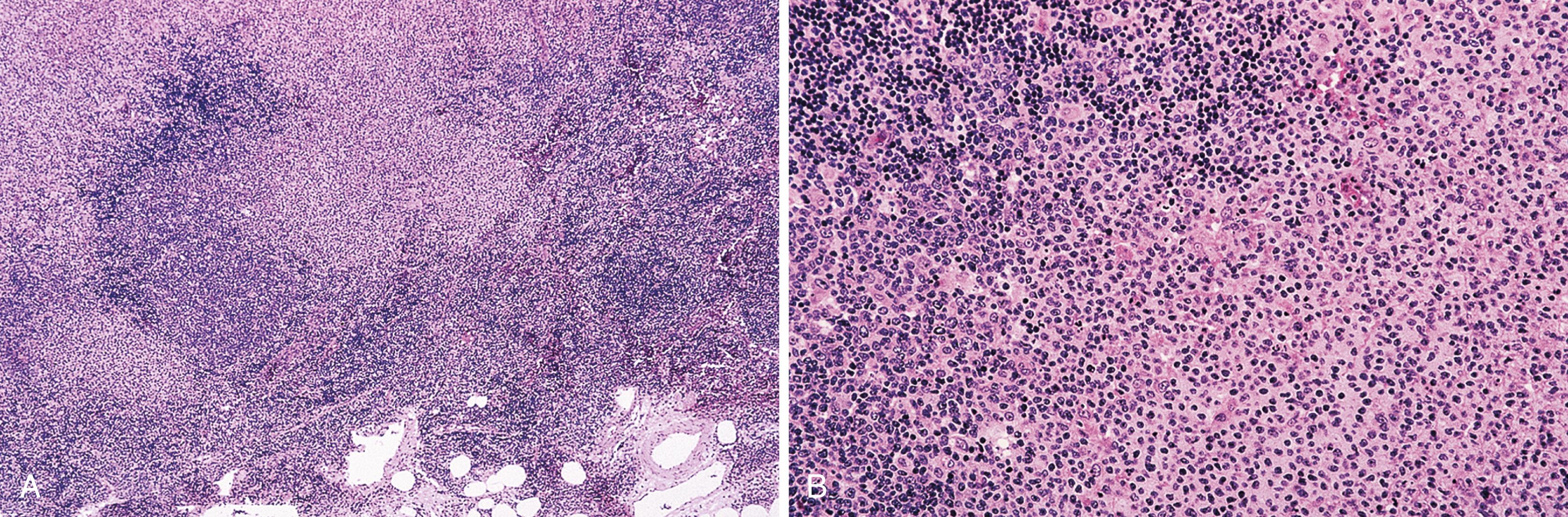 FIGURE 31.3, Perigastric lymph node involved by marginal-zone lymphoma.