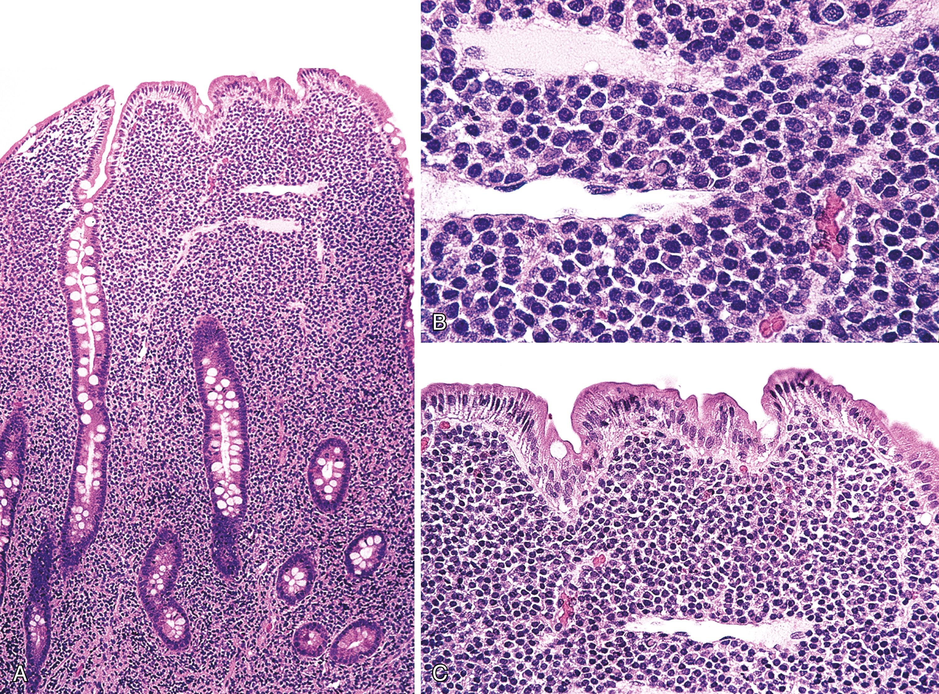 FIGURE 31.4, Immunoproliferative small intestinal disease (IPSID), stage A.