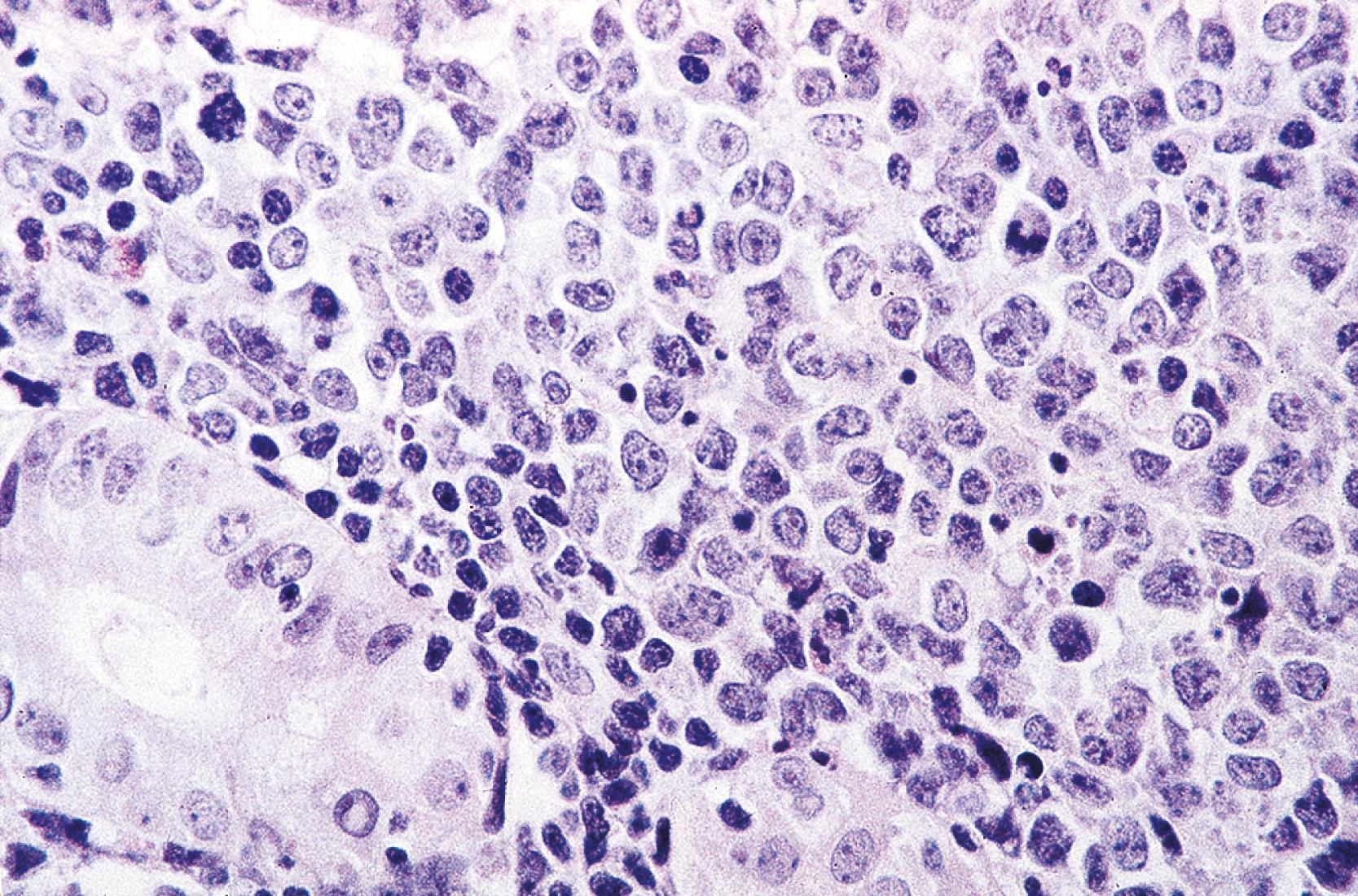 FIGURE 31.5, Gastric diffuse large B-cell lymphoma. The biopsy shows an infiltrate of centroblasts and immunoblasts with oval, vesicular nuclei, prominent nucleoli, and scant cytoplasm, with occasional mitotic figures and interspersed cellular debris.