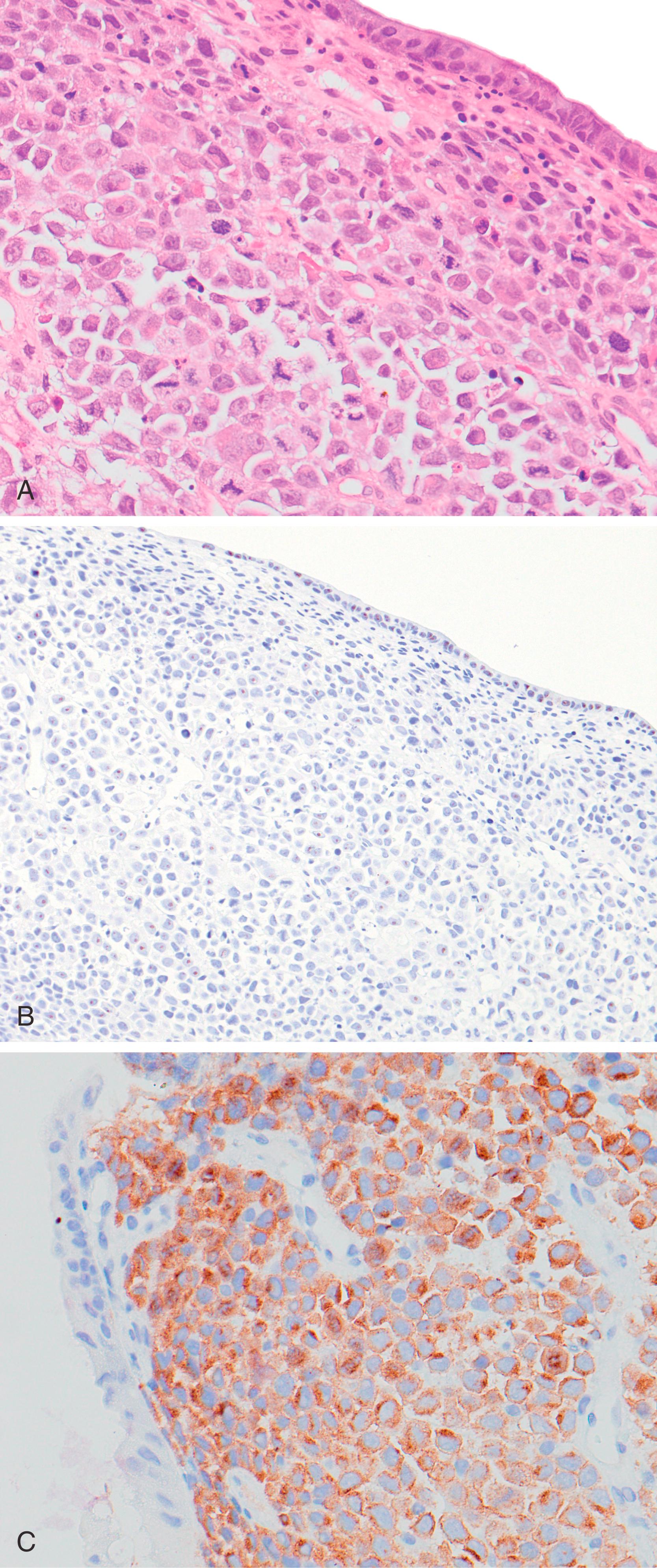 FIGURE 31.6, ALK+ diffuse large B-cell lymphoma, gastric relapse of lymph nodal primary.