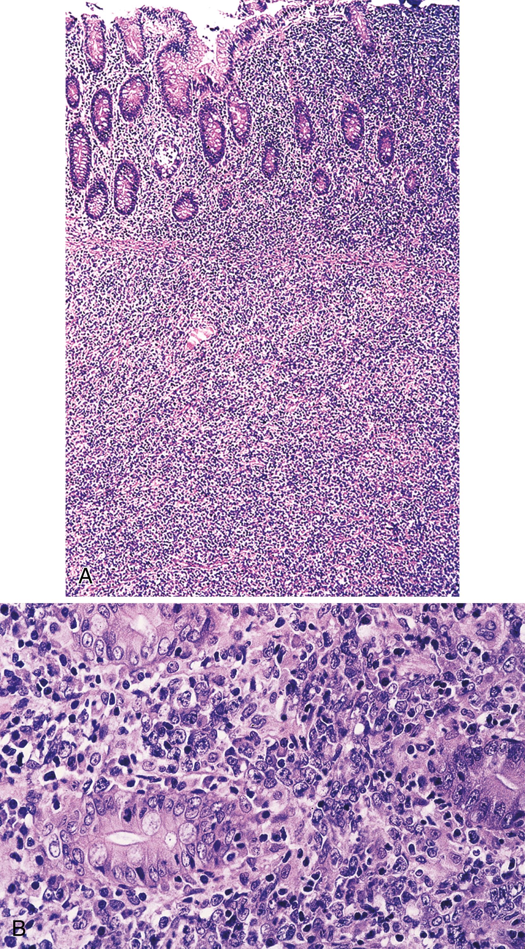 FIGURE 31.7, Diffuse large B-cell lymphoma, arising in the cecum of an HIV+ patient.