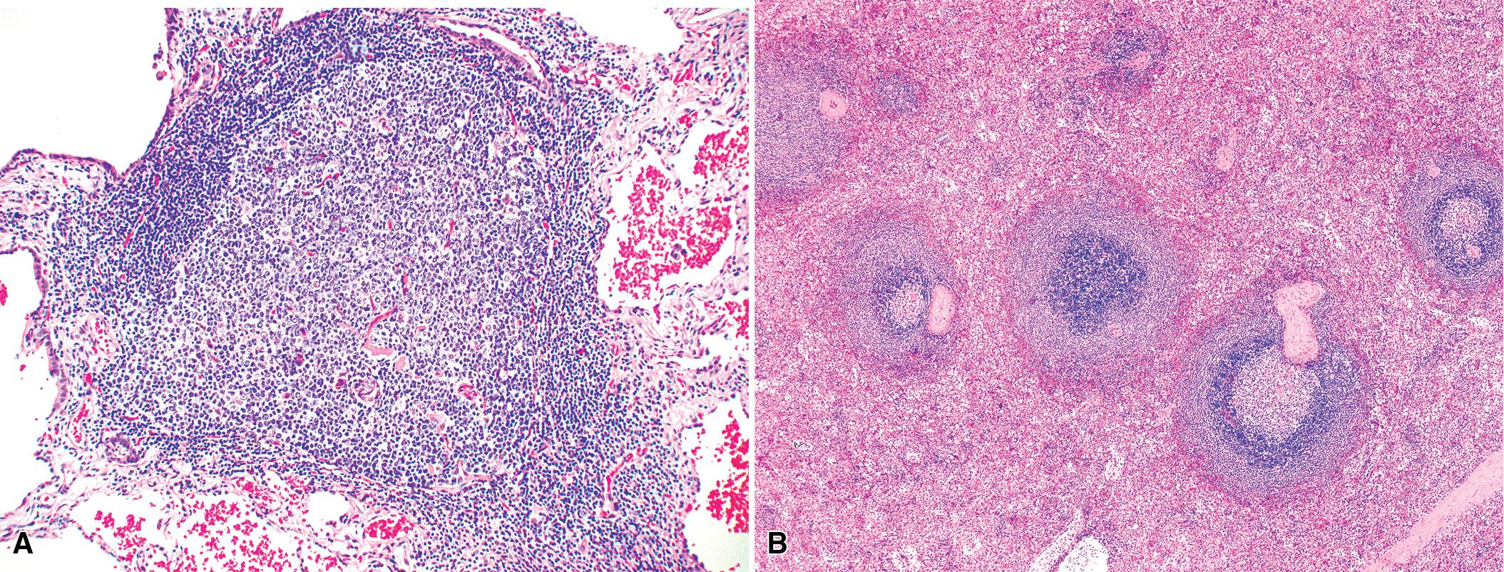 Figure 16.1, (A) Benign mucosa-associated lymphoid tissue accumulates adjacent to the airways after exposure to immunogenic material. The proliferation represents a mixture of B and T lineage lymphocytes, with a structure that loosely recapitulates germinal centers. The marginal zone is seldom so well developed as it is in the spleen. (B) When it is developed, consideration should be given to an evolving lymphoproliferative disorder.