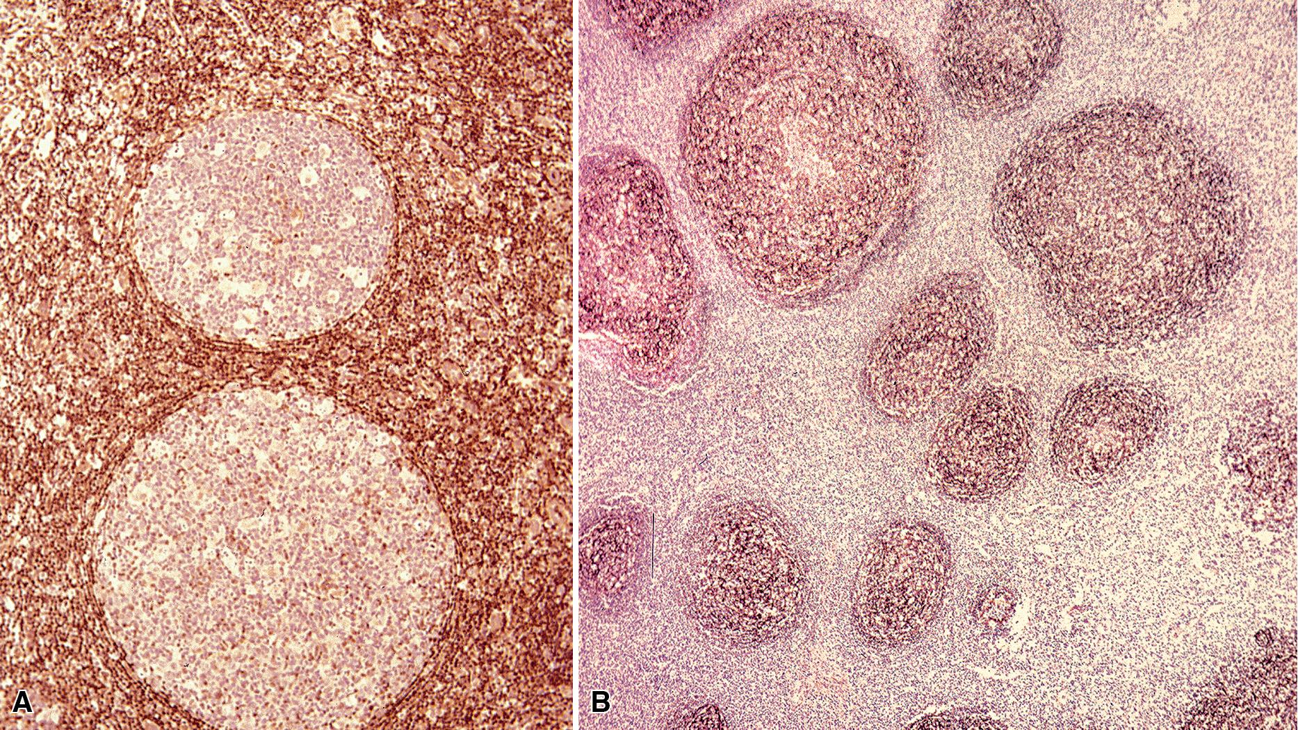 Figure 16.2, The normal immune-architecture of bronchiolar lymphoid tissue follows that seen elsewhere. Germinal centers are negative for bcl2 (A) and rich in CD21+ follicular dendritic cells (B) and bcl6+ centrocytes and centroblasts (C). (D) At low power, some of the follicles are polarized into light and dark zones. (E) At high power, there is a rich and heterogeneous mix of centrocytes and centroblasts, without a discernible increase in plasma cells or monocytoid cells. (F) It may be irregular in contour, but an immunoglobulin D–positive mantle is often present.