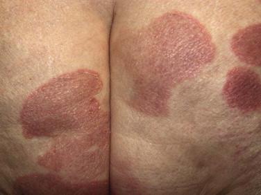 FIGURE 14-1, Erythematous patch lesions of mycosis fungoides.