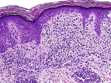 FIGURE 14-11, Mycosis fungoides. Plaque lesion with hyperchromatic epidermotropic lymphocytes and papillary dermal fibrosis with “wiry” collagen bundles.