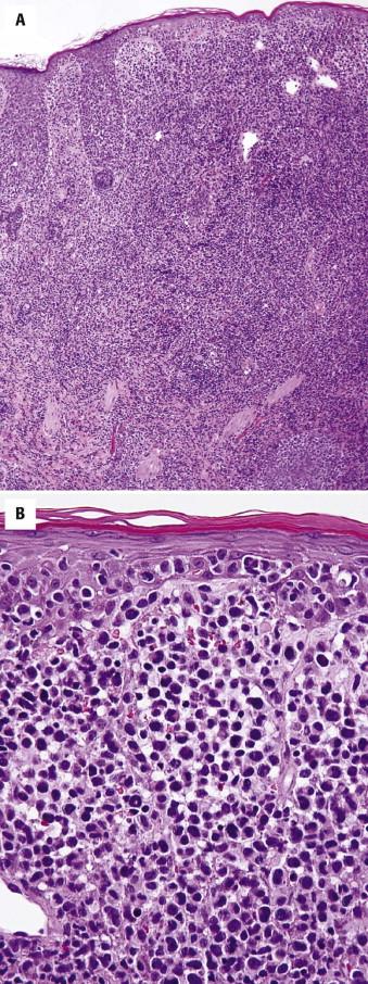 FIGURE 14-13, Mycosis fungoides. A, Tumor lesion with dense nodular dermal lymphoid infiltrate. B, The tumor is predominantly composed of large lymphocytes, indicating large cell transformation.