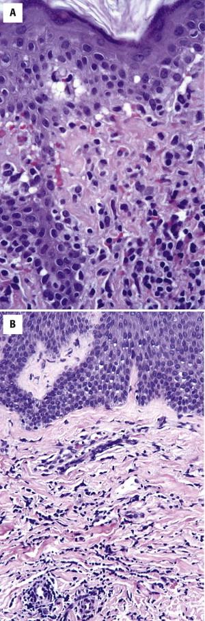 FIGURE 14-15, Variants of mycosis fungoides. A, Purpuric patch lesion with extravasated red blood cells. B, Interstitial pattern of distribution of lymphocytes.