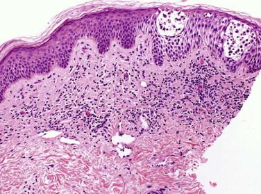 FIGURE 14-16, Eczematous mycosis fungoides. There is bandlike infiltrate. The epidermis shows spongiosis.