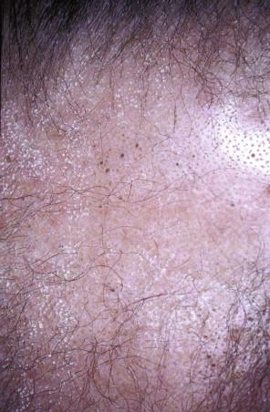 FIGURE 14-18, Folliculotropic mycosis fungoides presenting as alopecia associated with follicular spines and comedones.