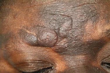 FIGURE 14-19, Plaque lesions of folliculotropic mycosis fungoides.