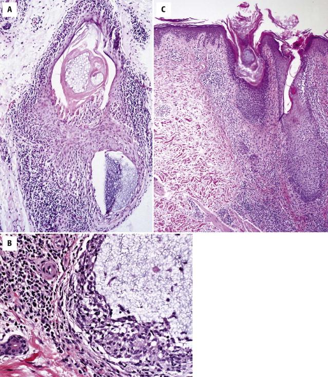 FIGURE 14-21, Folliculotropic mycosis fungoides with follicular mucinosis. A, Intrafollicular mucin is associated with a folliculotropic atypical lymphocytic infiltrate. B, The lymphocytes are atypical and manifest around as well as within the follicular epithelium. C, Follicular ostia may be ectatic and the infiltrate may spill over to the adjacent epidermis.
